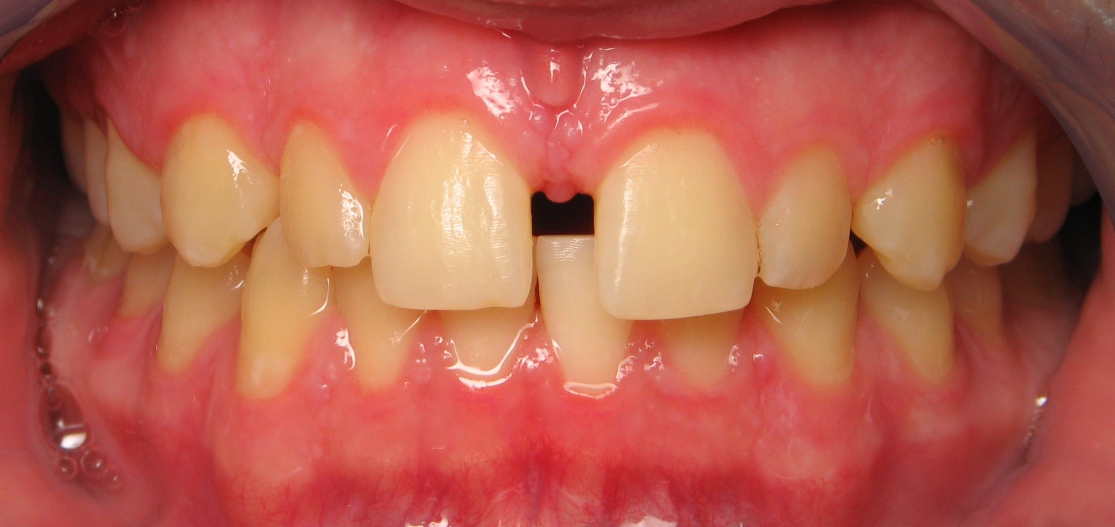 Before Orthodontic Treatment in San Tan Valley, AZ