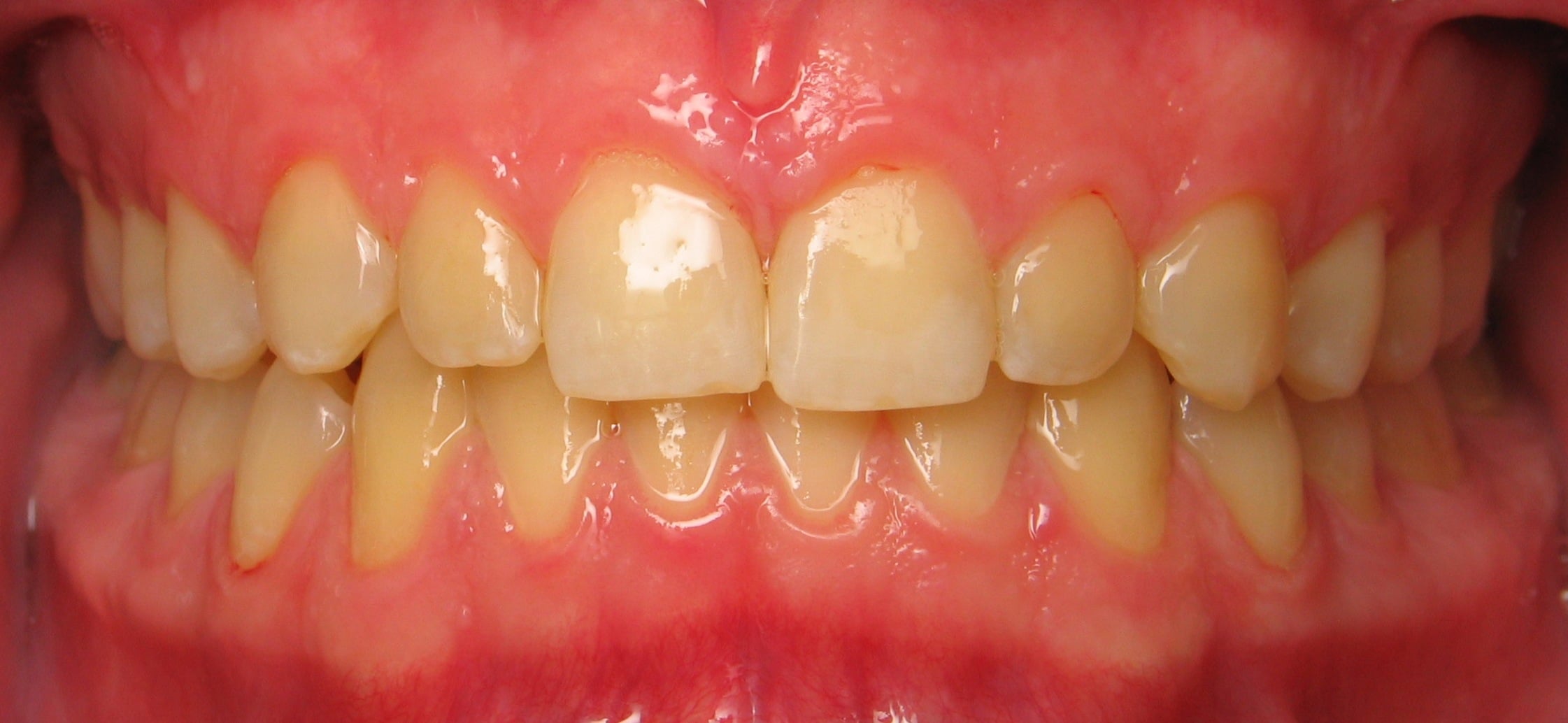 After Orthodontic Treatment in San Tan Valley, AZ