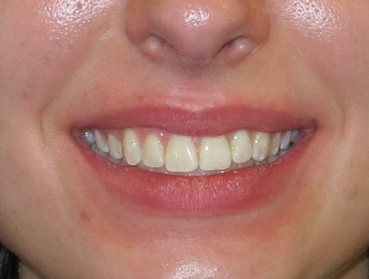 After Braces Treatment at San Tan Family Dentistry