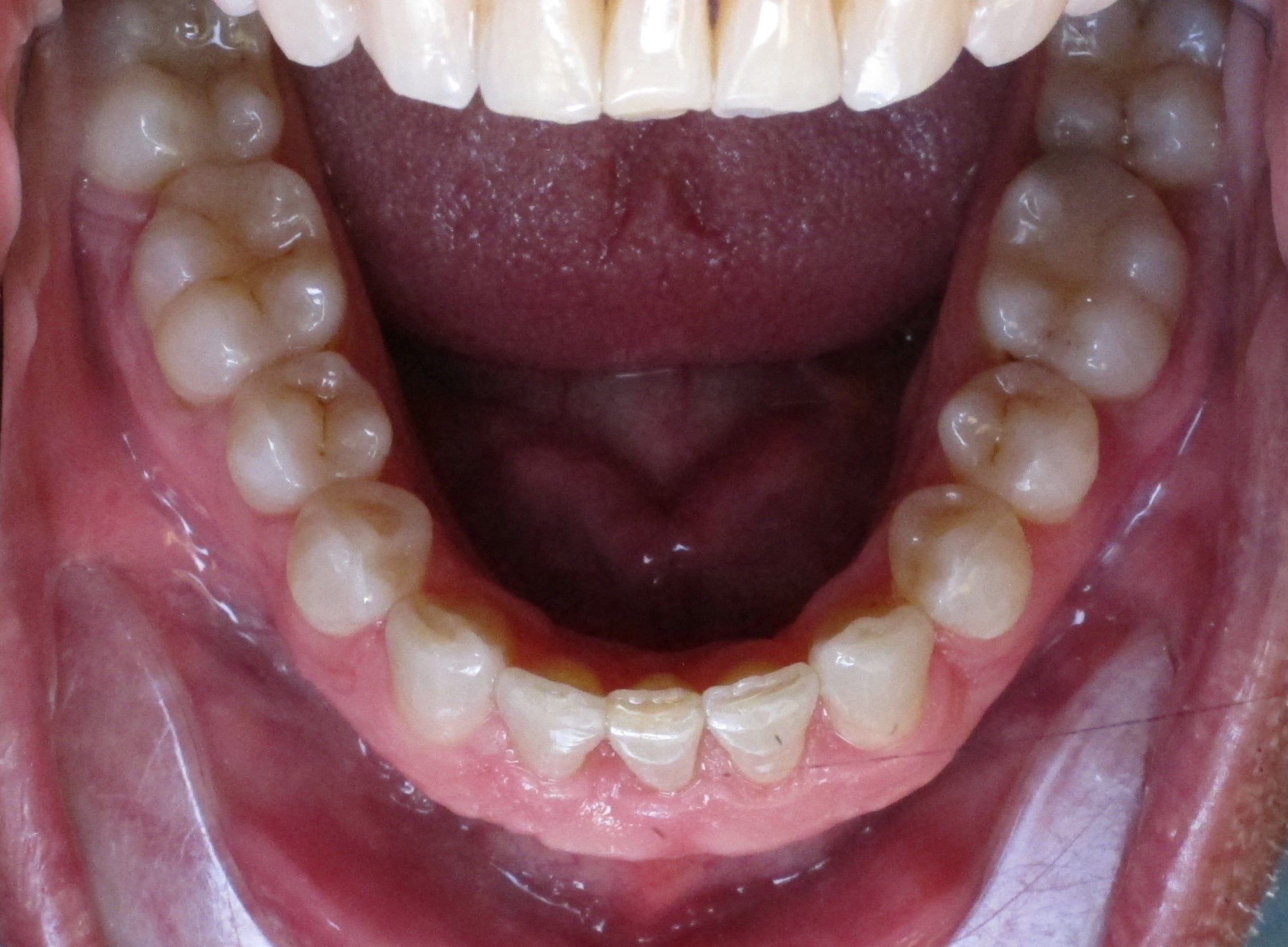 Bottom Teeth After Brace